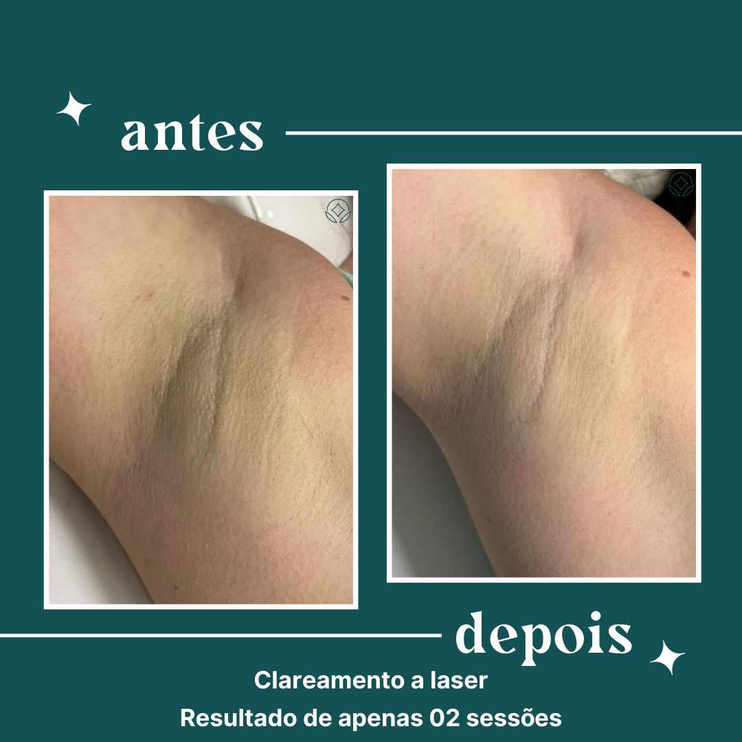 Resultado real de depilação e clareamento a laser na dipelle